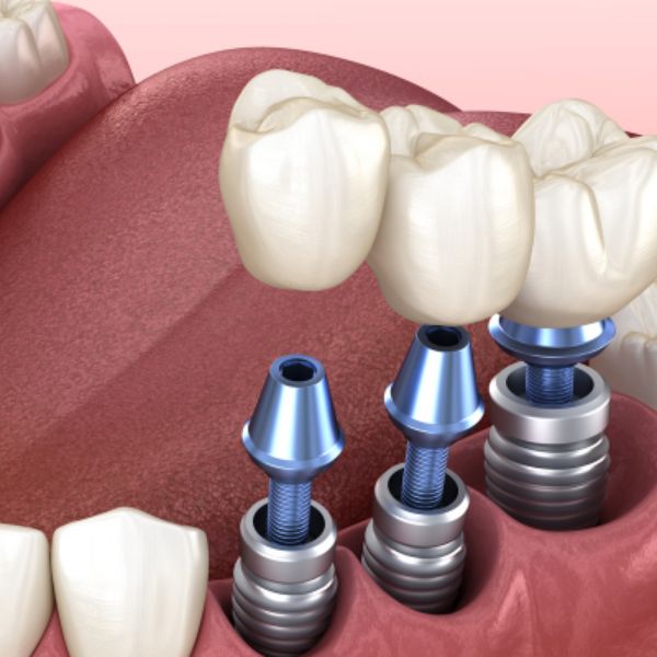 Đặt lịch cấy Ghép implant tại booking heal