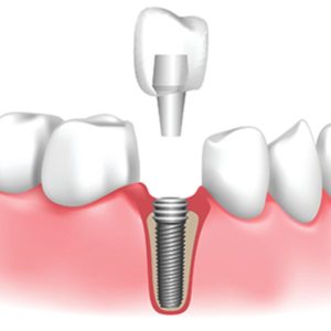 cấy ghép và phục hồi răng mất implant