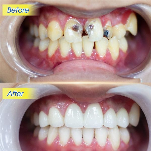 đặt lịch Phục hình răng tại booking heal