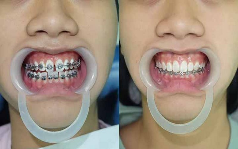 Niềng răng là một trong những thế mạnh dịch vụ tại nha khoa Smile One