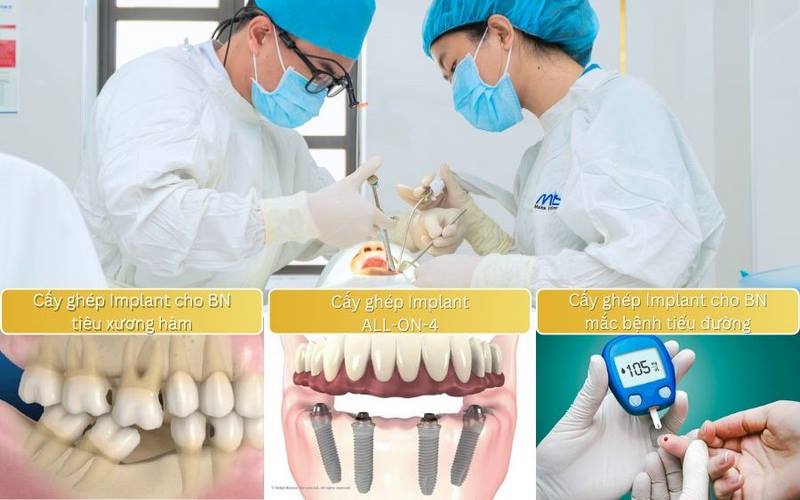 Kỹ thuật trồng implant hiện đại được ứng dụng tại nha khoa I - DENT