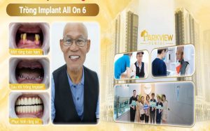 Khách hàng hài lòng khi phục hình răng implant tại nha khoa Parkview Dental 