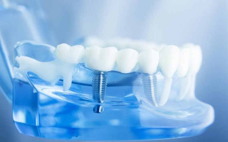 Kỹ thuật trồng implant tại nha khoa Đăng Lưu