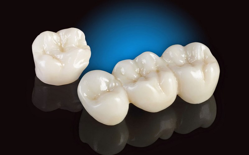 Chất liệu sứ chính hãng, cao cấp là yếu tố cần chú ý khi chọn nha khoa bọc sứ