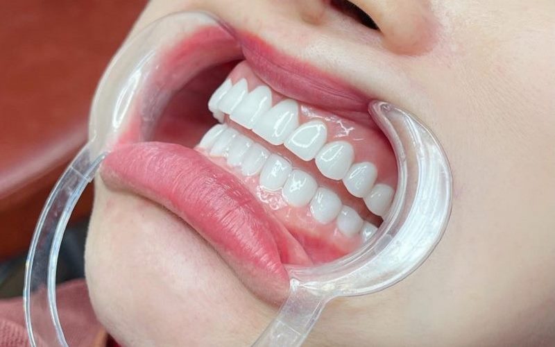 Bọc răng sứ thẩm mỹ, giá tốt tại nha khoa Shinbi