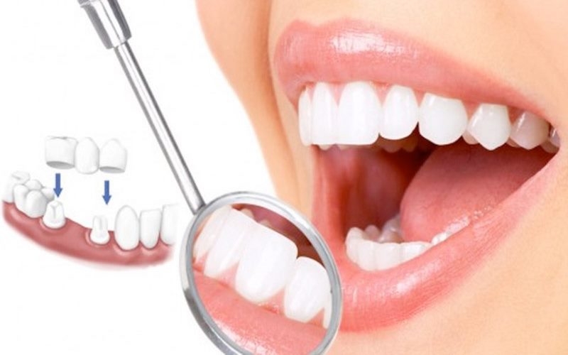 Win Smile là địa chỉ chuyên bọc răng sứ thẩm mỹ uy tín lâu năm tại Hà Nội