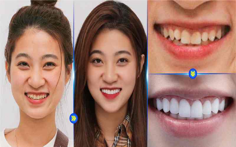 Sở hữu răng sứ chuẩn đẹp khi chọn nha khoa Lisiam