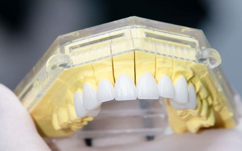 Kỹ thuật làm răng sứ hiện đại tại nha khoa Paris