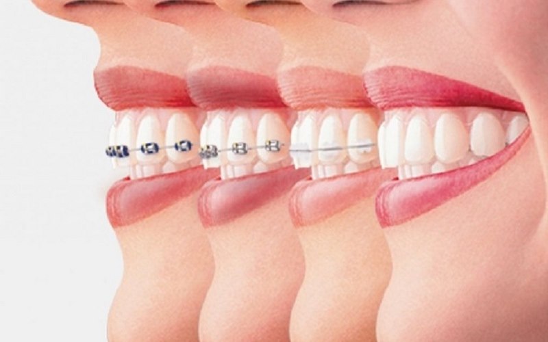 Nha khoa niềng răng uy tín có nhiều lựa chọn kỹ thuật chỉnh nha khác nhau