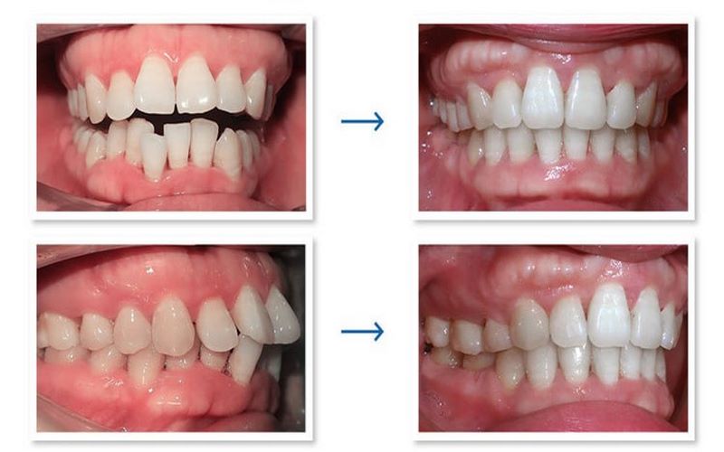 Kết quả niềng răng hoàn hảo tại nha khoa Đăng Lưu