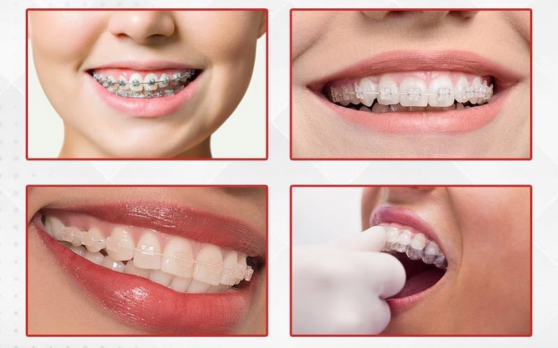 Tâm Đức Smile hỗ trợ khách hàng nhiều phương pháp niềng răng tiên tiến