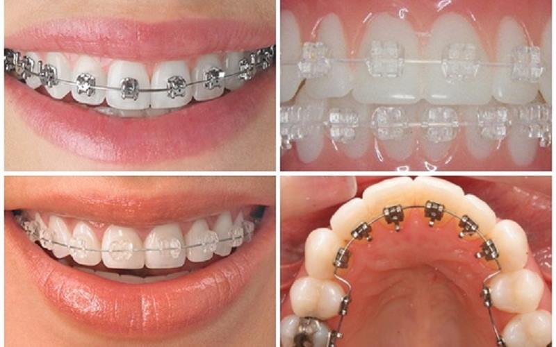 Các phương pháp niềng răng tiên tiến tại Up Dental