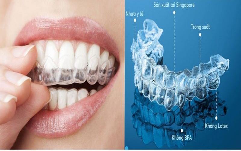 Niềng răng trong suốt thẩm mỹ cao tại nha khoa Kim