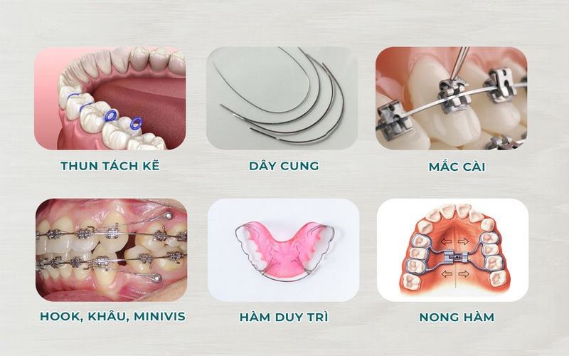 Vật liệu chỉnh nha chuẩn FDA Hoa Kỳ tại nha khoa Elite Dental