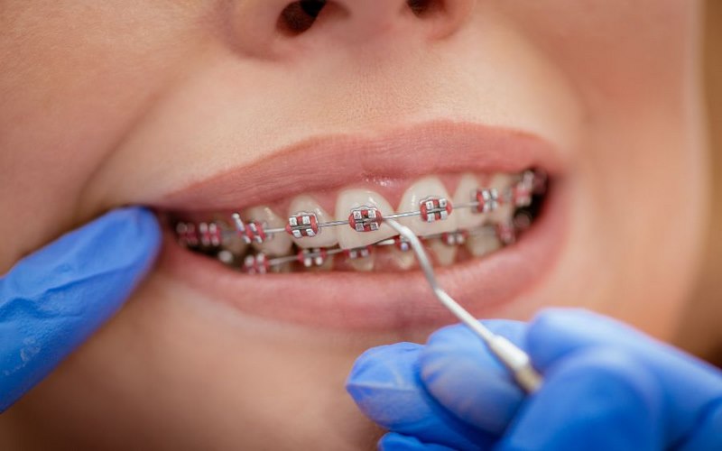 Dịch vụ niềng răng chuyên nghiệp, an toàn tại Smile One 