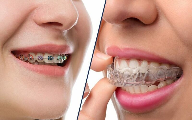 Kỹ thuật niềng răng hiện đại tại nha khoa Việt Pháp 