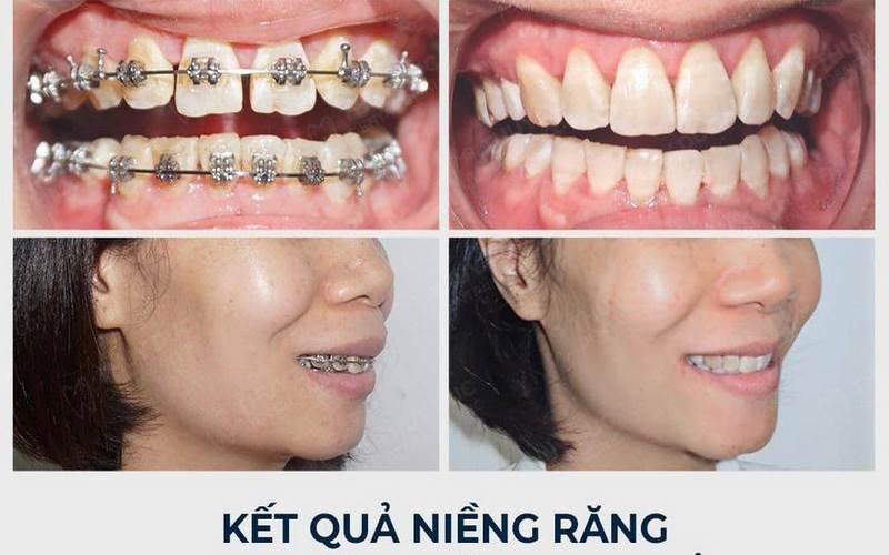 Kết quả niềng răng lý tưởng tại nha khoa Việt Đức