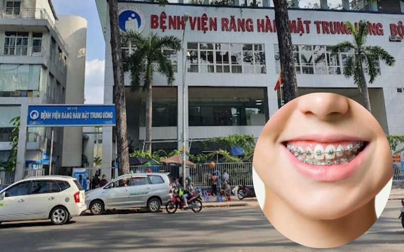 Bệnh viện Răng Hàm Mặt TW – Địa chỉ chỉnh nha uy tín ở Hà Nội
