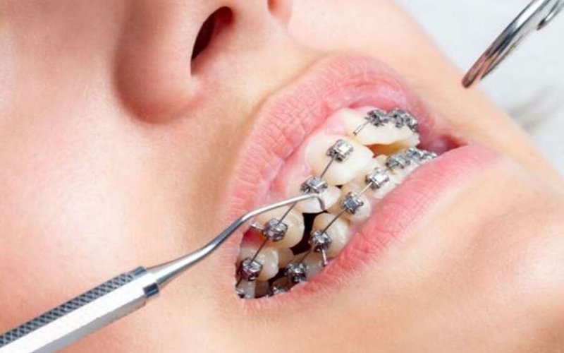 Quy trình niềng răng đạt chuẩn, an toàn tại khoa răng bệnh viện ĐH Y Hà Nội