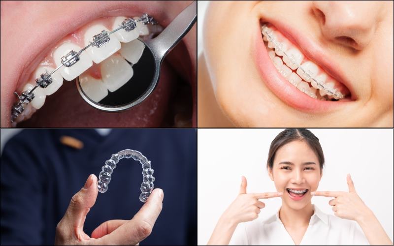 Việt Smile là nha khoa uy tín để chọn khi cần chỉnh nha tại Hà Nội