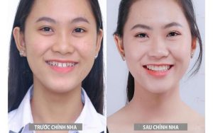 Kết quả niềng răng chất lượng tại bệnh viện Quân đội 108