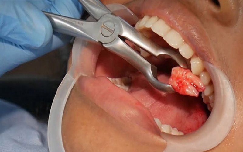 Nha khoa nhổ răng khôn uy tín sử dụng thiết bị vô trùng 