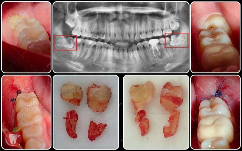 Nhổ răng khôn an toàn, nhanh chóng tại Saigon Dental Implant Center