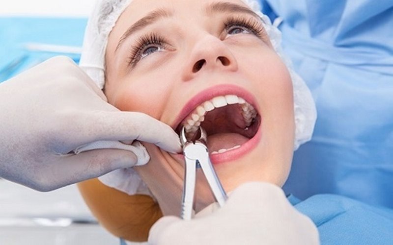 Nhổ răng khôn ở nha khoa Trồng răng Sài Gòn  