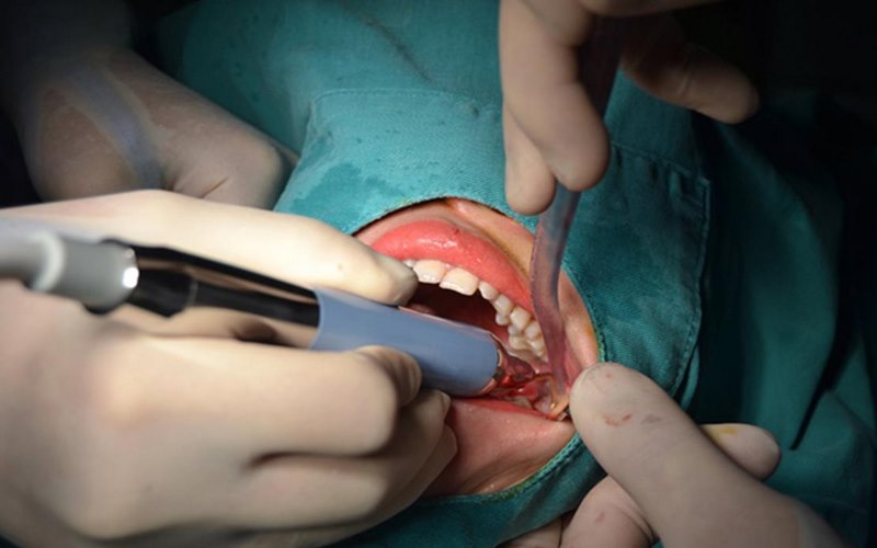 Kỹ thuật nhổ răng khôn hiện đại tại Bệnh viện Răng Hàm Mặt Sài Gòn