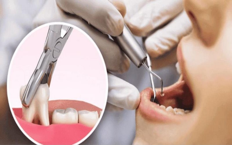 Khách hàng yên tâm khi trải nghiệm dịch vụ nhổ răng khôn tại Vigor Health 
