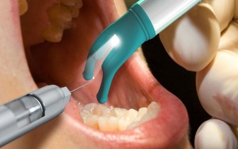 Nhổ răng khôn theo quy trình chuẩn y khoa tại nha khoa Đăng Lưu