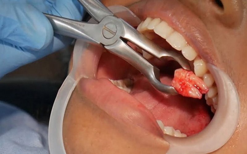Bác sĩ Smile One nhổ răng khôn không đau