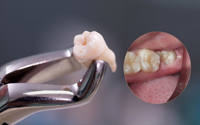 Kỹ thuật nhổ răng khôn tại khoa Răng – Bệnh viện Quân y 103