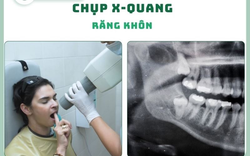 Nha khoa Paris ứng dụng công nghệ hiện đại, quy trình nhổ răng khôn vô trùng