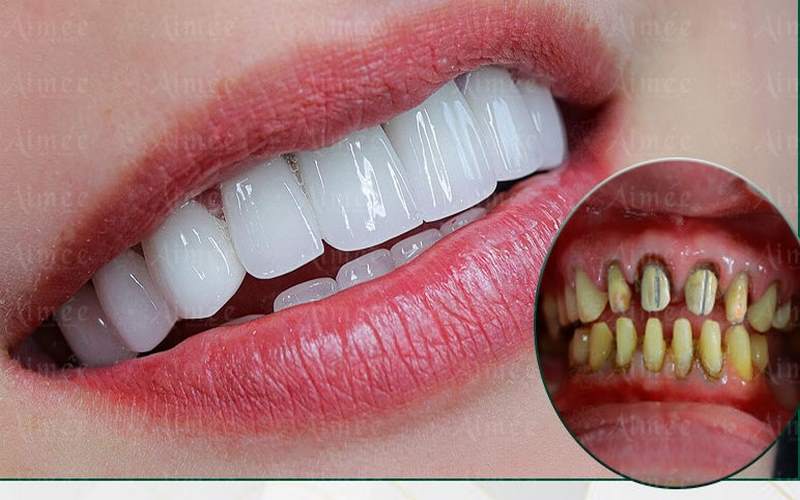 Tâm Đức Smile là địa chỉ uy tín chuyên làm răng sứ thẩm mỹ tại Quận 9 - TPHCM