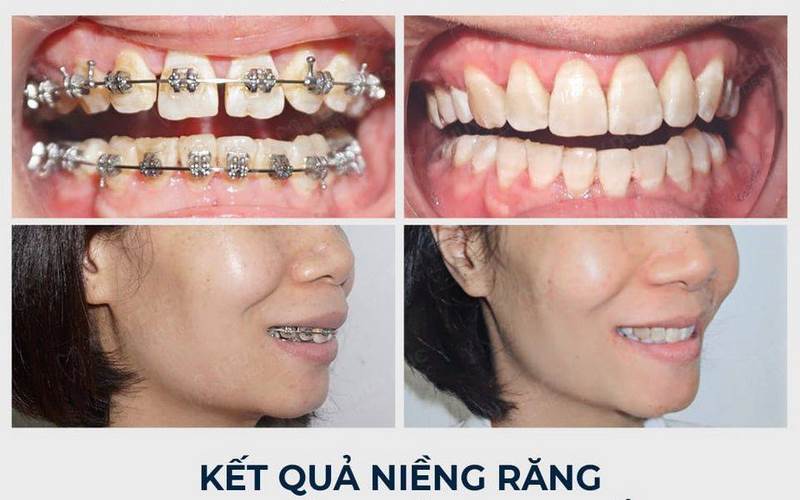 Kết quả niềng răng hoàn hảo tại nha khoa Pháp Việt