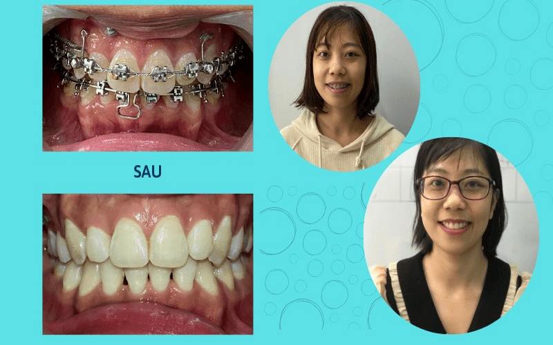 Nụ cười tự tin của khách hàng sau niềng răng tại Nha khoa Dr. Tiên