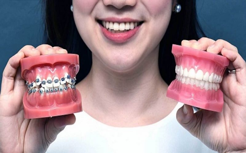 Kỹ thuật chỉnh nha chuyên sâu tại nha khoa Parkway Quận 3 