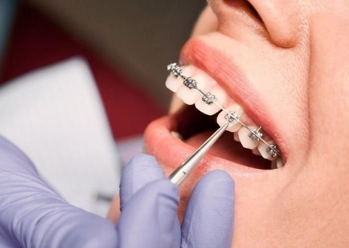 Cân nhắc nhiều yếu tố khi chọn nha khoa niềng răng tại Quận 8 