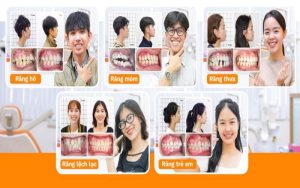 Vô số khách hàng đã hài lòng với kết quả chỉnh nha tại Up Dental