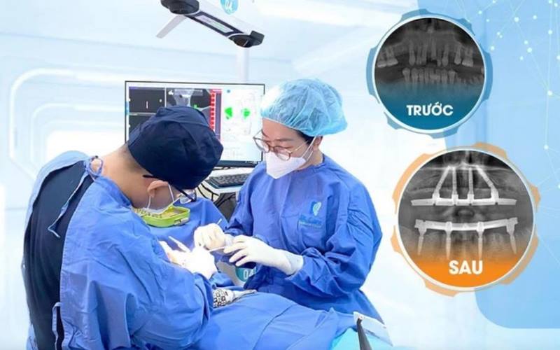 Công nghệ trồng implant tiến tiến tại nha khoa Dr. Care 