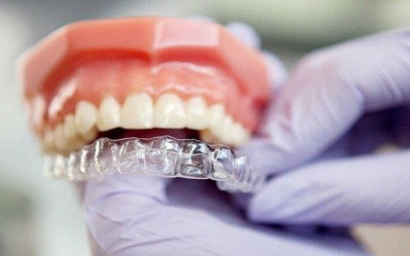 Kỹ thuật niềng răng bằng công nghệ hiện đại tại Dana Dental 