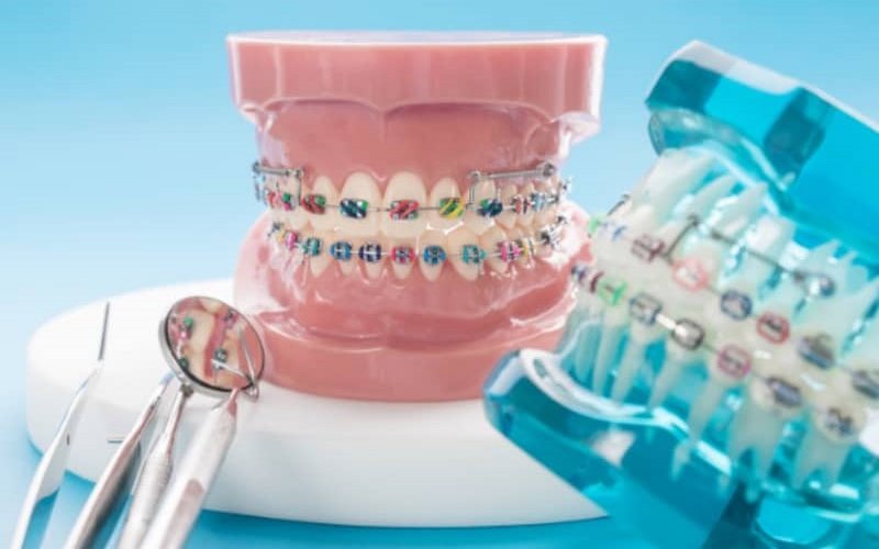 Niềng răng công nghệ hiện đại tại nha khoa Tâm Đức Smile 