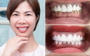 Công nghệ chỉnh nha và thẩm mỹ răng tại VIET SMILE